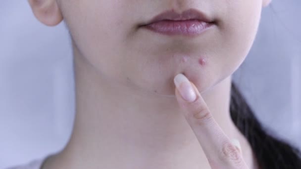 Hautpflege Eine Junge Frau Blickt Auf Einen Pickel Ihrem Gesicht — Stockvideo