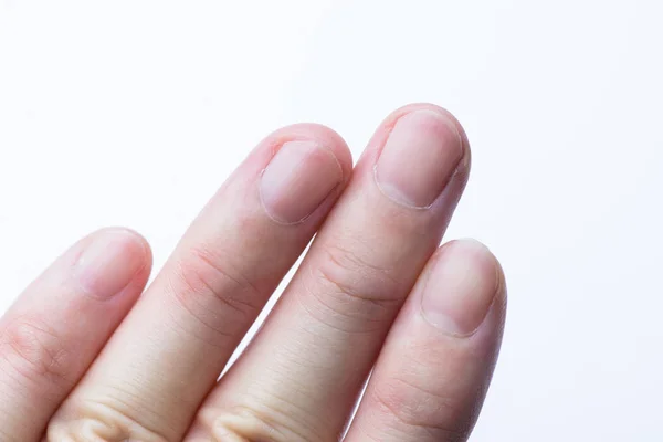 Close Van Man Vinger Nail Witte Achtergrond — Stockfoto