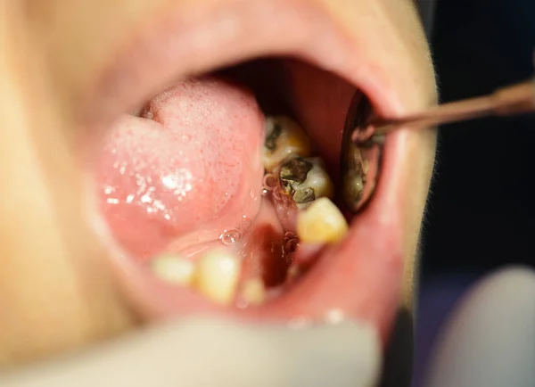 Primer Plano Del Dentista Revisando Los Dientes Rotos — Foto de Stock