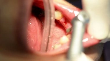 Diş hekimi diş sondaj kadar kapatın