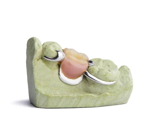 Denture Sur Plâtre Modèle Isolé Sur Fond Blanc — Photo