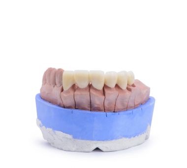 Tüm seramik son derece estetik diş köprü ve alçı model labotary tacı