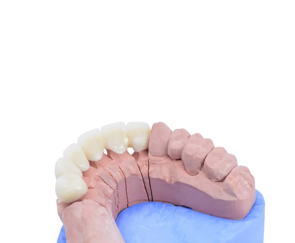 Закрыть Зубной Керамической Модели Белом Фоне — стоковое фото