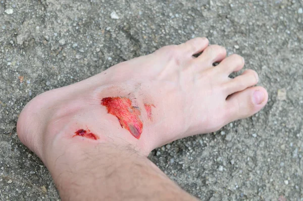 因意外事故而造成新伤口磨损的人的脚 — 图库照片