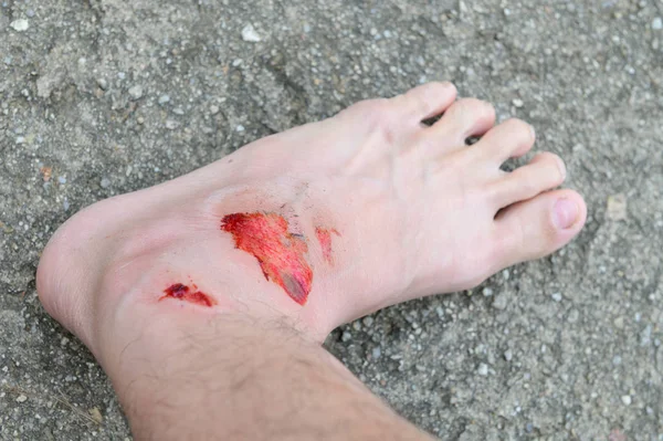 Closeup Humano Com Abrasão Ferida Fresca Acidente — Fotografia de Stock