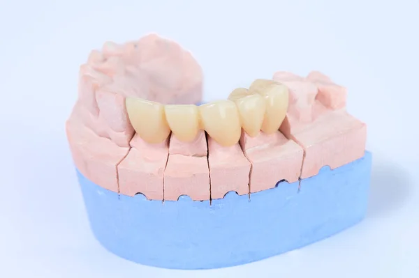 Керамическая Зубная Корона Гипсовой Модели — стоковое фото
