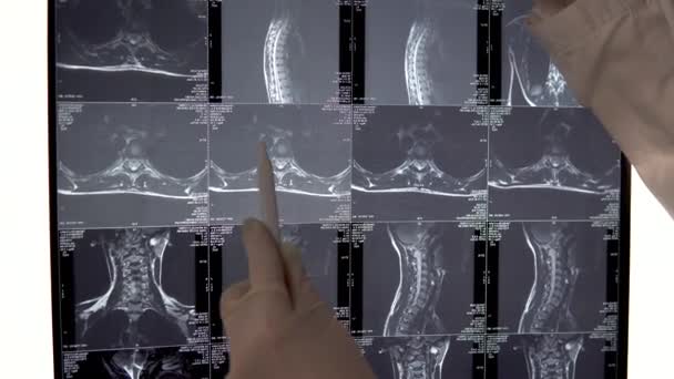El médico verifica los resultados de la resonancia magnética de la columna vertebral del tórax. El médico examina la imagen de la resonancia magnética y muestra los lugares especiales de la imagen con una pluma. . — Vídeo de stock