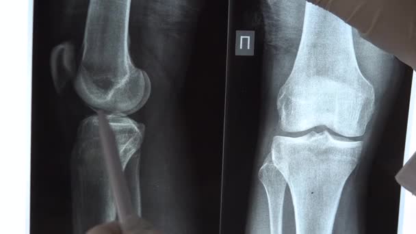 医者は膝関節のX線の結果をチェックします。医師はX線の画像を調べ、ペンで画像内の特別な場所を示しています。. — ストック動画