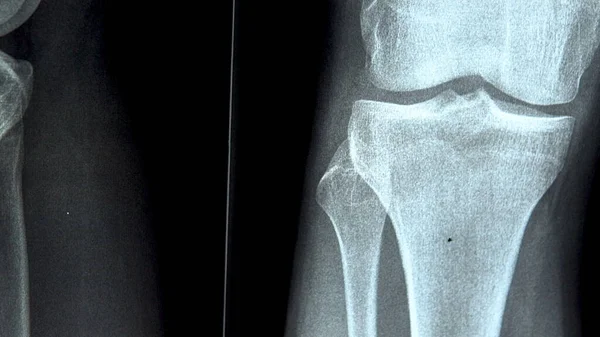 Raggi X dell'articolazione del ginocchio primo piano. Immagine a raggi X dal basso verso l'alto — Foto Stock