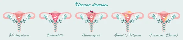 Women health - infographics. Uterus diseases - Anatomical schemes. Gynecological diseases - adenomyosis, fibroid e.t.c. — Stock Vector