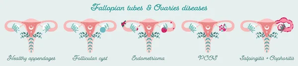 Kadın Sağlığı Fallop Tüpleri Yumurtalık Bozuklukları Pcos Endometrioma Jinekolojik Hastalıklar — Stok Vektör