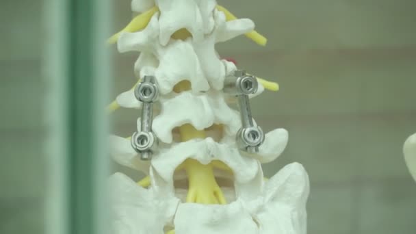 Przykład Protez Kręgosłupa Ludzkiego Metalowymi Protezami Stojącymi Szklanym Pudełku — Wideo stockowe