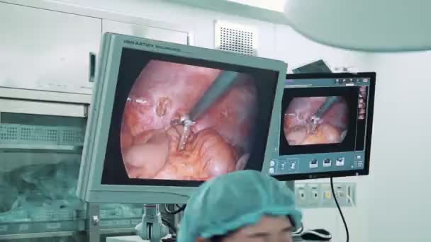 การด วยว Laparoscopic อมผลล ของอว ยวะภายในของผ วยไปย งจอภาพ — วีดีโอสต็อก