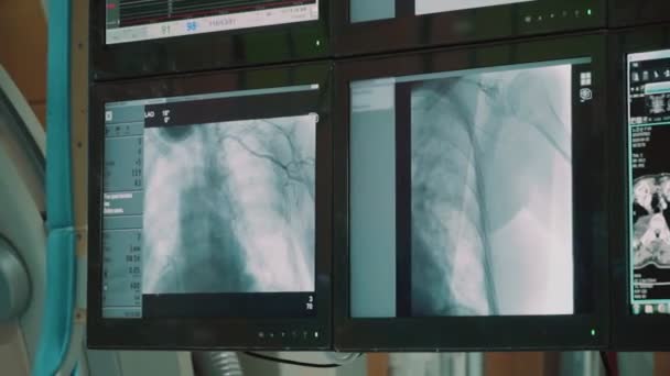Modernt Medicinskt Operationssal Där Läkare Undersöker Monitorer Med Biometriska Data — Stockvideo