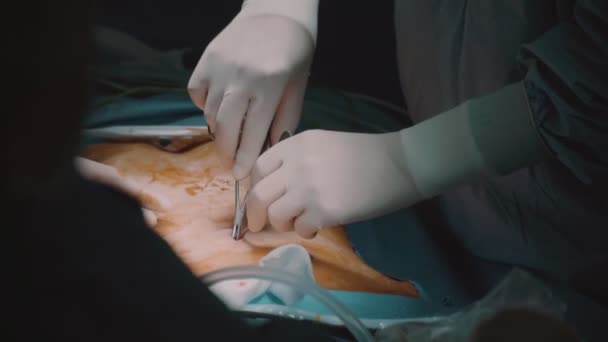 腹腔镜手术的现代医疗手术室 医生在病人的腹腔开刀 — 图库视频影像
