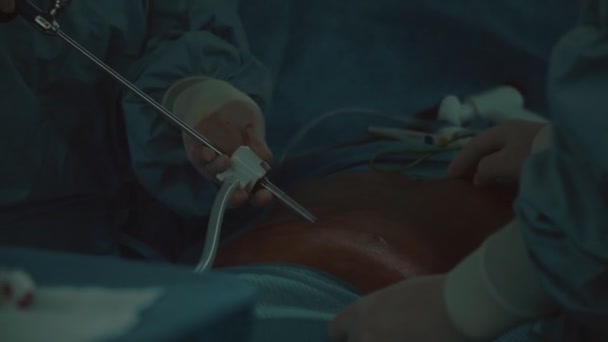 Operação Por Método Laparoscópico Por Vários Médicos Com Sala Cirurgia — Vídeo de Stock