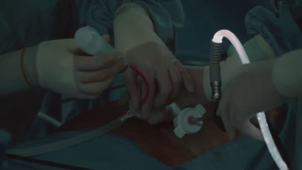 Operacja Metodą Laparoskopową Przez Kilku Lekarzy Salą Operacyjną — Wideo stockowe