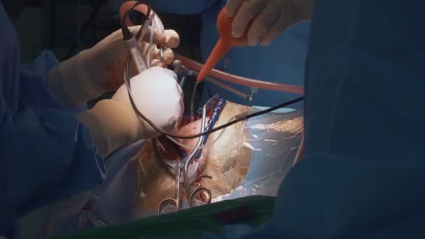 Chirurgo Esegue Interventi Chirurgici Sul Cranio Una Persona Con Consacrazione — Video Stock