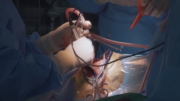 Surgeon Performs Surgery Skull Person Operative Consecration Operating Room — Stock Video