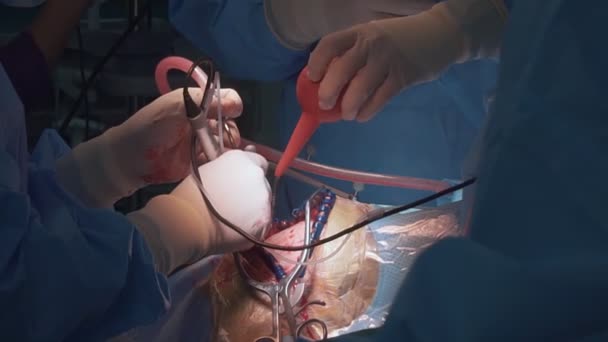 Surgeon Performs Surgery Skull Person Operative Consecration Operating Room — Stock Video