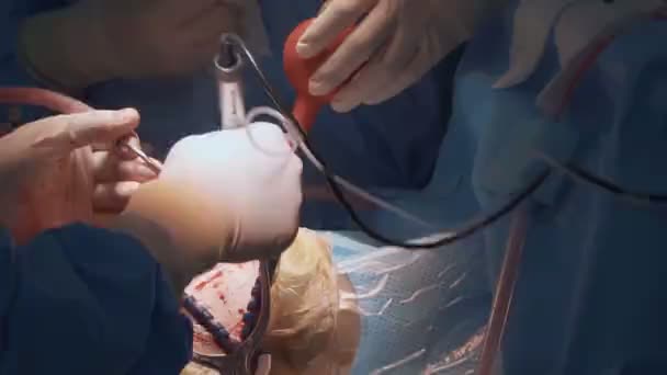 外科医生对在手术室做手术的人的颅骨进行手术 — 图库视频影像