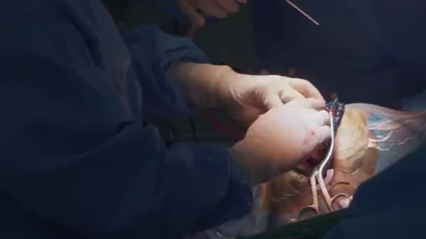 外科医は手術室で手術を受ける人の頭蓋骨に手術を行います — ストック動画