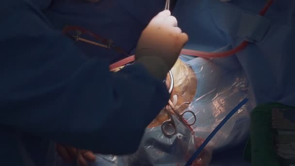 Surgeon Performs Surgery Skull Person Operative Consecration Operating Room — Stock Video