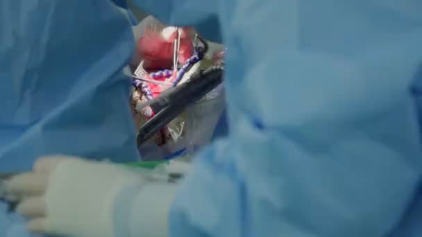 Sebész Műtétet Végez Egy Operációs Felszenteltséggel Rendelkező Személy Koponyáján Műtőben — Stock videók