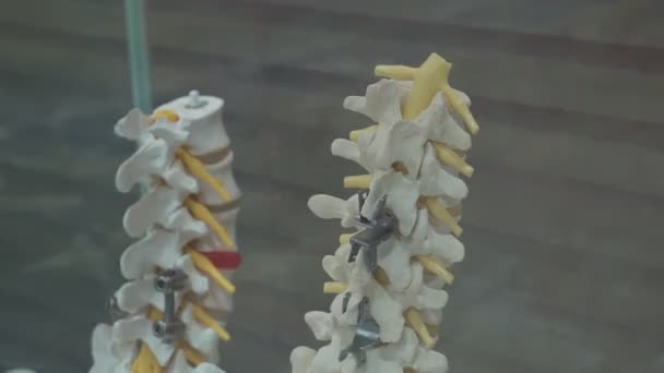 Ejemplo Prótesis Columna Vertebral Humana Con Prótesis Metálicas Pie Una — Vídeo de stock