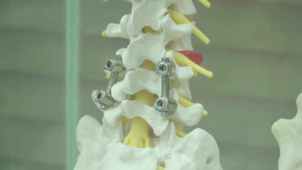 Пример Протезирования Позвоночника Человека Металлическими Протезами Стоящими Стеклянной Коробке — стоковое видео