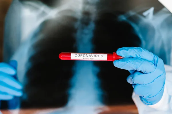 Läkare Specialiserad Lungmedicin Som Håller Radiologisk Lungröntgen Film För Medicinsk — Stockfoto