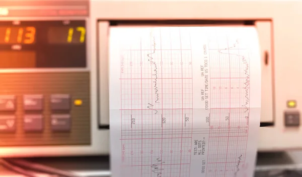 Impression Rapport Cardiogramme Provenant Salle Accouchement Electrocardiograph Iin — Photo