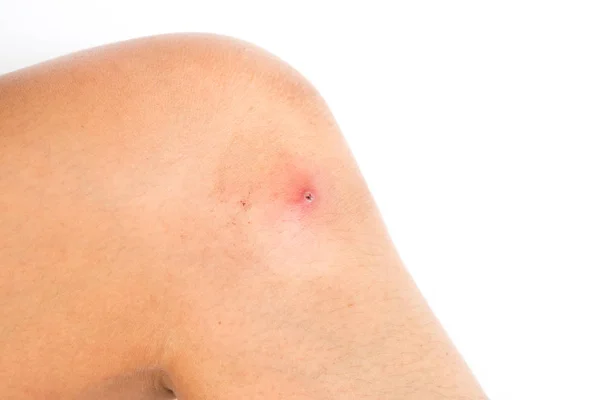 Wound on skin. — Stock Photo, Image