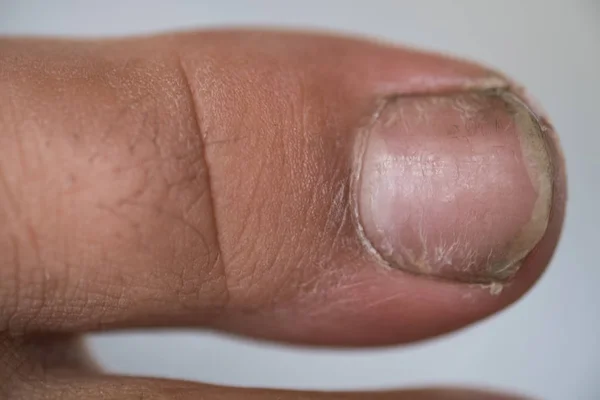 Dirty children finger nails. Dirty finger nails. — Stock Photo, Image