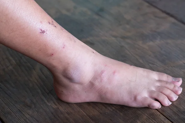Piernas heridas, Síndrome del pie diabético . — Foto de Stock