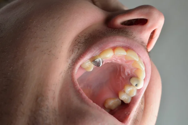 부패 치아와 남자 환자 입소문 닫습니다. 치과 건강 — 스톡 사진