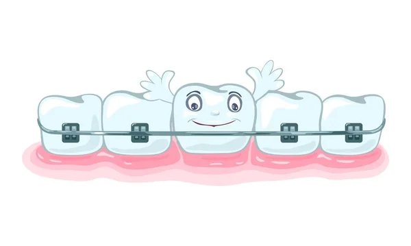 Χρήση μεταλλικών οδοντικών στηριγμάτων, ορθοδοντικών στηριγμάτων για τη διόρθωση απόφραξης, ευθυγράμμιση οδοντοστοιχίας. — Διανυσματικό Αρχείο