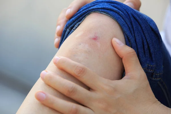 Vista Cerca Las Manos Sobre Rodilla Con Herida — Foto de Stock