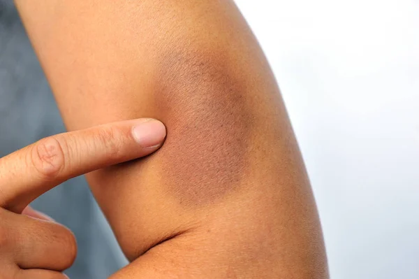 Bruised and injured female arm — Stock Photo, Image