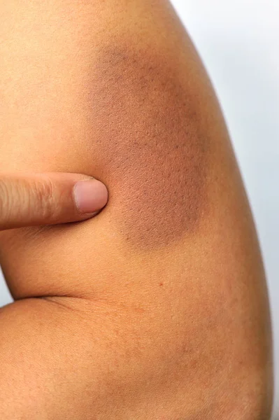 Bruised and injured female arm — Stock Photo, Image