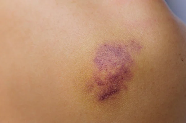 Zraněná žena rameno — Stock fotografie