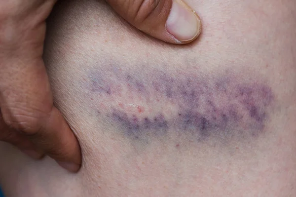 Μώλωπας Τραυματισμού Στο Γόνατο Νεαρή Γυναίκα Κλείνω Πάνω Θέα — Φωτογραφία Αρχείου