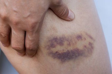 yaralı bacak elinde tutan grubu  