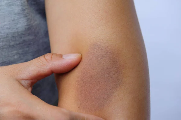 Mujer Con Brazo Herido Sosteniendo Mano — Foto de Stock