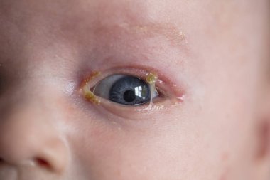 A close up of a young baby with a common sore sticky eye infection clipart