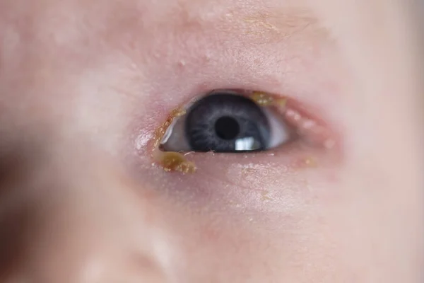 Een close-up van een jonge baby met een gewone pijnlijke plakkerige ooginfectie — Stockfoto