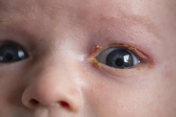 Un primer plano de un bebé pequeño con una infección común del ojo dolorido pegajoso —  Fotos de Stock