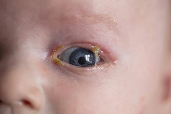Een close-up van een jonge baby met een gewone pijnlijke plakkerige ooginfectie — Stockfoto