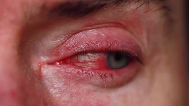 Un primer plano de un severo ojo inyectado en sangre. Blefaritis, Conjuntivitis — Vídeo de stock