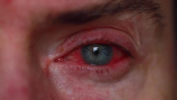 Close up of a severe bloodshot eye. Blepharitis, Conjunctivitis condition — Stock Video